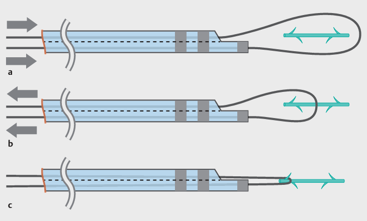 図2b：自作スネアにて迷入ステントを抜去